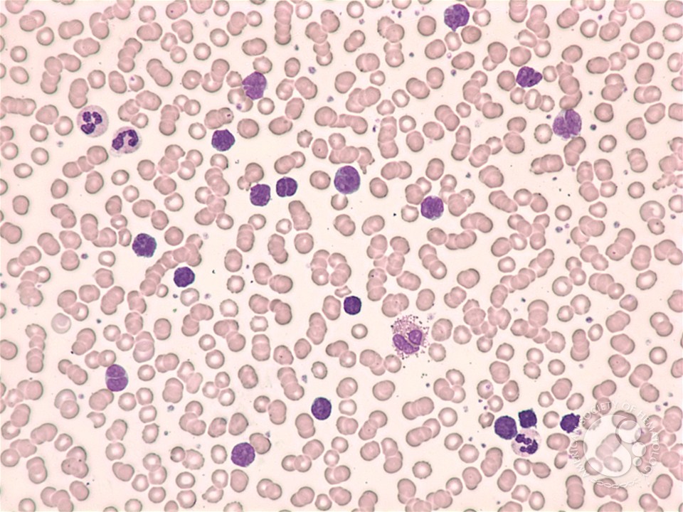 Adult T-cell leukemia /  lymphoma