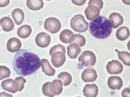 Adult T-cell leukemia / lymphoma