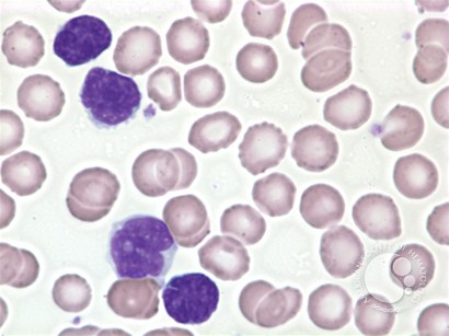 Adult T-cell leukemia / lymphoma