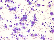 Large B-cell lymphoma presenting as a pleural effusion - 1