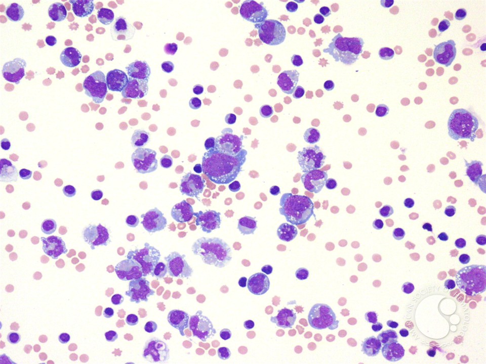 Large B-cell lymphoma presenting as a pleural effusion - 1