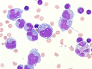 Large B-cell lymphoma presenting as a pleural effusion - 2