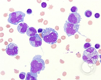 Large B-cell lymphoma presenting as a pleural effusion - 2