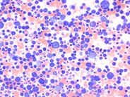 Primary effusion lymphoma - 1.