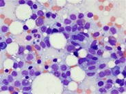 Hairy cell leukemia - 2.