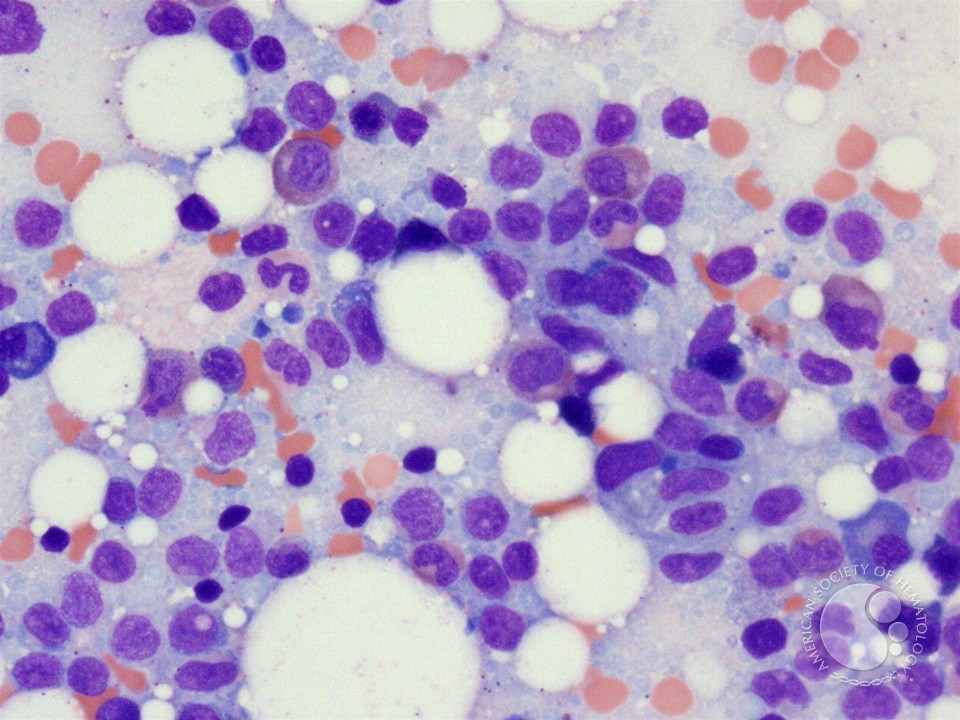 Hairy cell leukemia - 2.