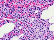Hairy cell leukemia - 3.