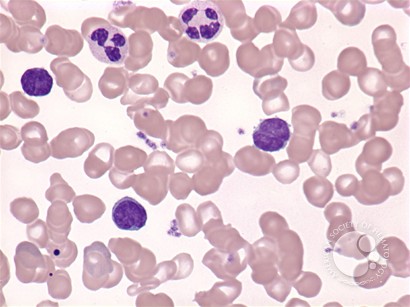 Marginal zone lymphoma: leukemic phase - 2.