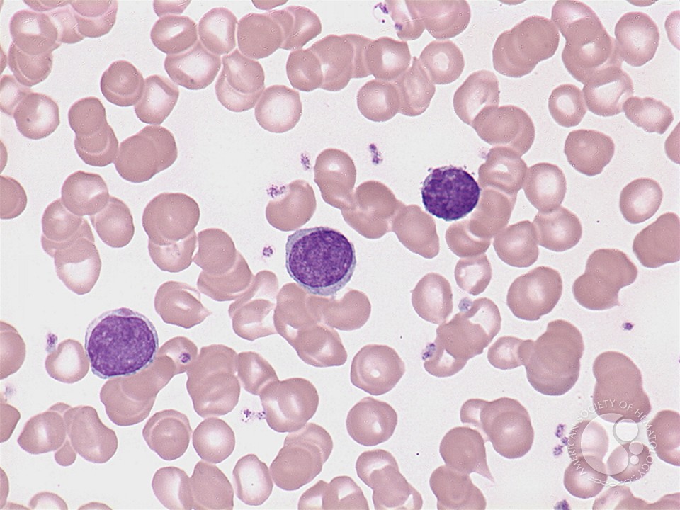 Marginal zone lymphoma: leukemic phase - 3.