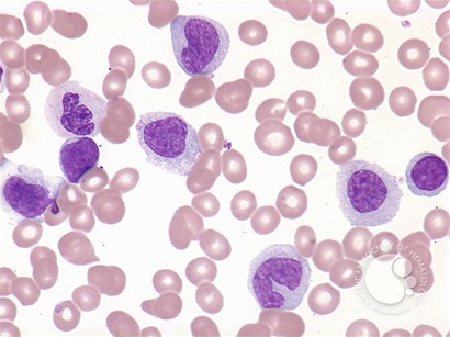 Acute myelomonocytic leukemia - 1.