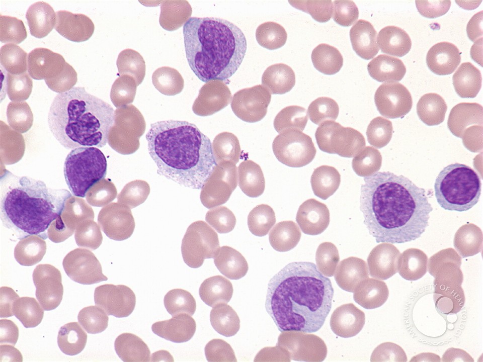 Acute myelomonocytic leukemia - 1.
