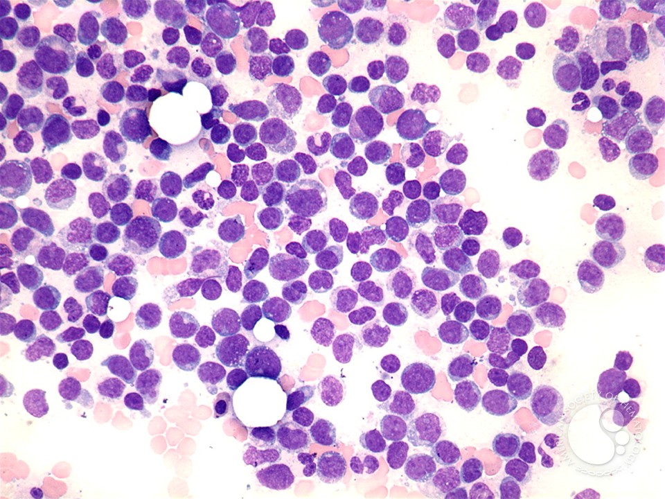 Acute myelomonocytic leukemia - 2.