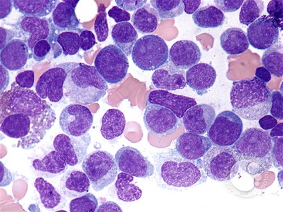 Acute myelomonocytic leukemia - 3.