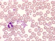 Essential thrombocythemia: peripheral smear - 5.