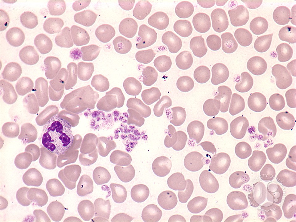 Essential thrombocythemia: peripheral smear - 5.