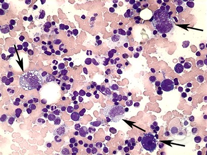 Anaplastic large cell lymphoma - bone marrow aspirate - 1.