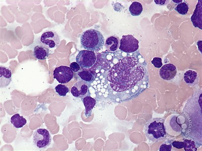 Anaplastic large cell lymphoma - bone marrow aspirate - 2.