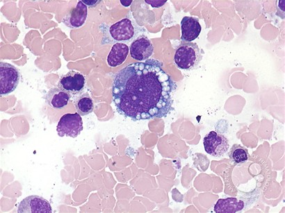 Anaplastic large cell lymphoma - bone marrow aspirate - 3.