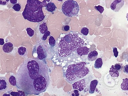 Anaplastic large cell lymphoma - bone marrow aspirate - 4.