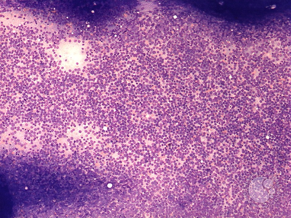 AML with maturation - 3.