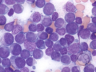 AML with maturation - 5.