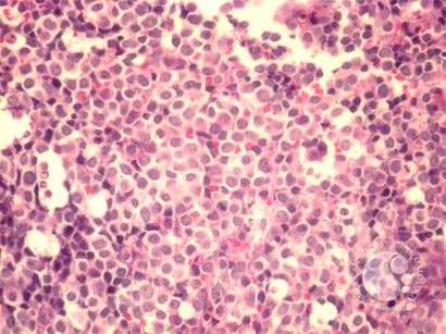 AML with maturation - 7.
