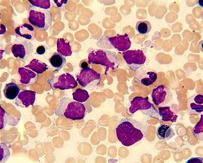 blastic plasmacytic dendritic cell neoplasm
