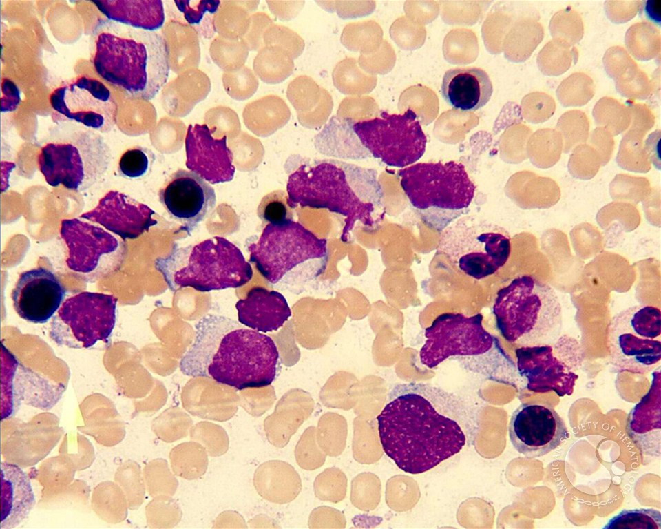blastic plasmacytic dendritic cell neoplasm