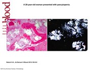 Bone Marrow Oxalosis