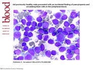 Auer rods in mature granulocytes of a patient with mixed lineage leukemia