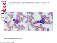 Burkitt lymphoma-leukemic phase