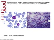 Aleukemic variant of mast cell leukemia