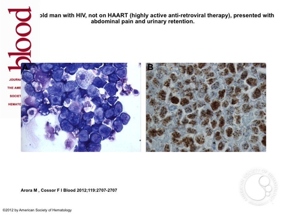 Diagnosis of extracavitary primary effusion lymphoma by urine cytology