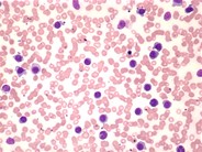 Hairy cell leukemia: variant - 1.