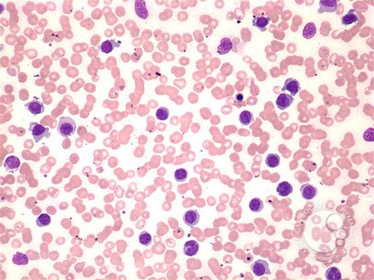 Hairy cell leukemia: variant - 1.