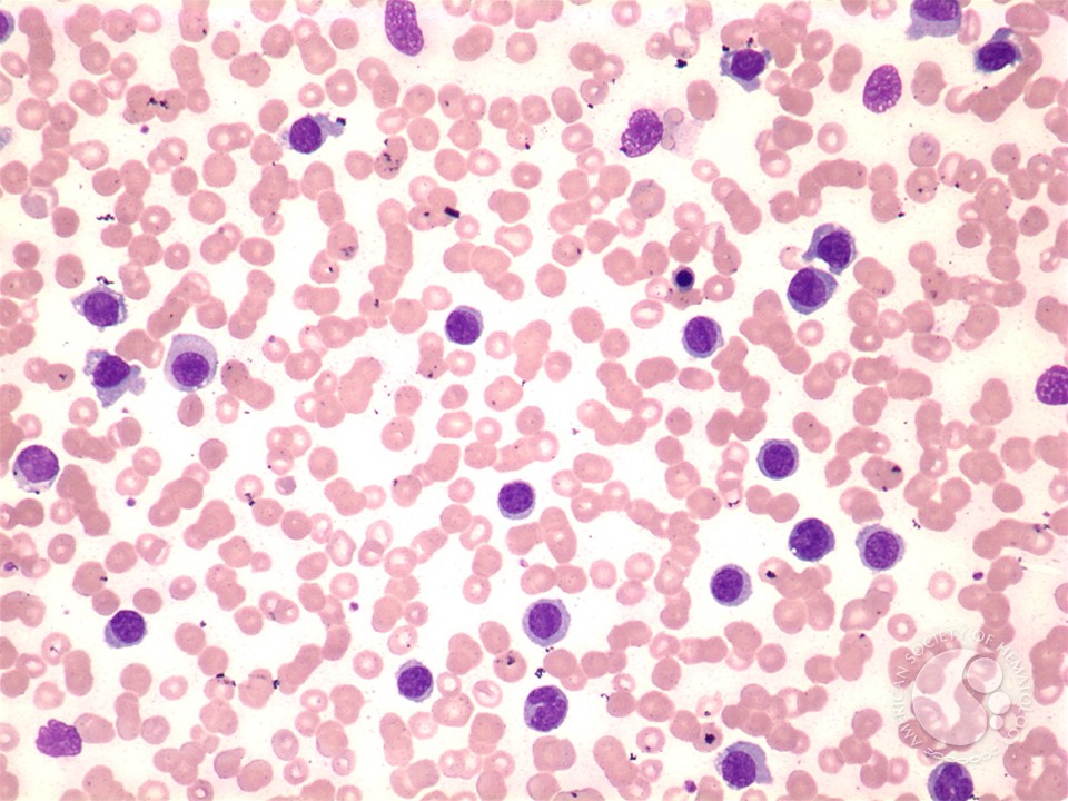 Hairy cell leukemia: variant - 1.