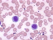 Hairy cell leukemia variant 2.