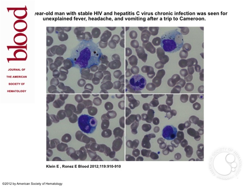 Peripheral hemophagocytosis in malaria infection