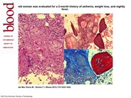 Marrow noncaseating granulomas: sarcoidosis