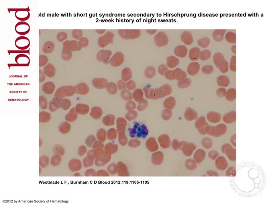 Yeast-like intraleukocytic inclusions in a peripheral smear