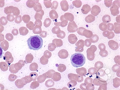 Hairy cell leukemia: variant - 2.