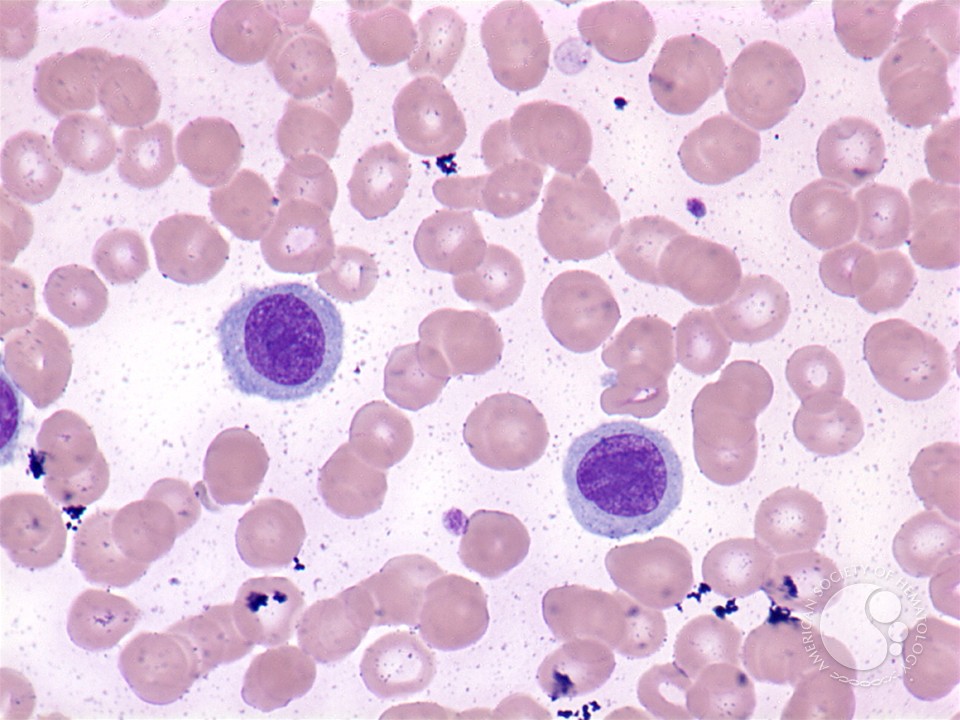 Hairy Cell Leukimia 41