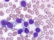 Hairy cell leukemia: variant - 3.