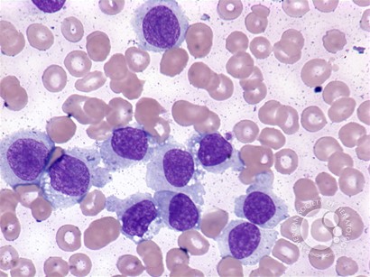 Hairy cell leukemia: variant - 3.