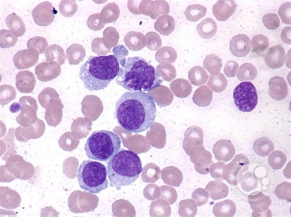 Hairy cell leukemia: variant - 4.