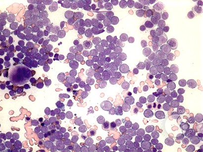 AML without maturation - 1.