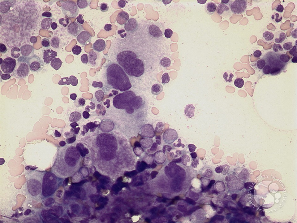 AML with inv(3) - 3.