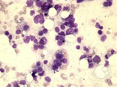 Extranodal NK/T-cell lymphoma - 1.