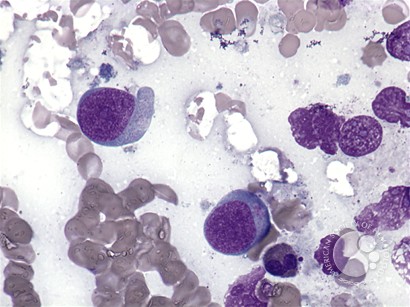 Extranodal NK/T-cell lymphoma - 2.