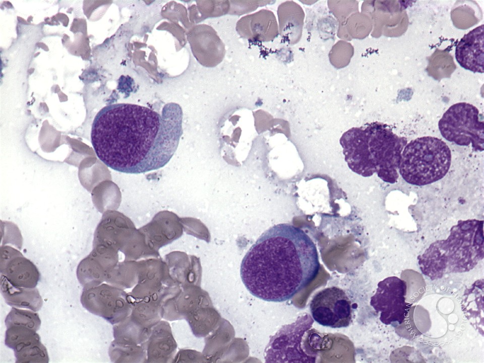 Extranodal NK/T-cell lymphoma - 2.